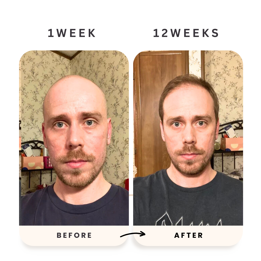 Celara™- Scalp Renewal Kit