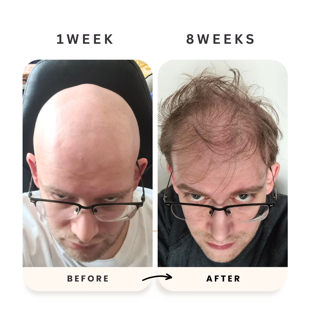 Celara™- Scalp Renewal Kit