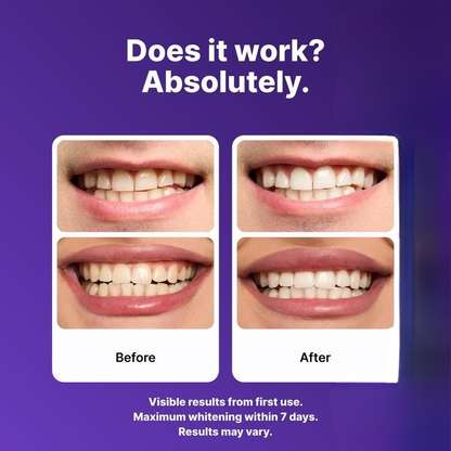 Smileva™ - Purple Teeth Whitening Strips