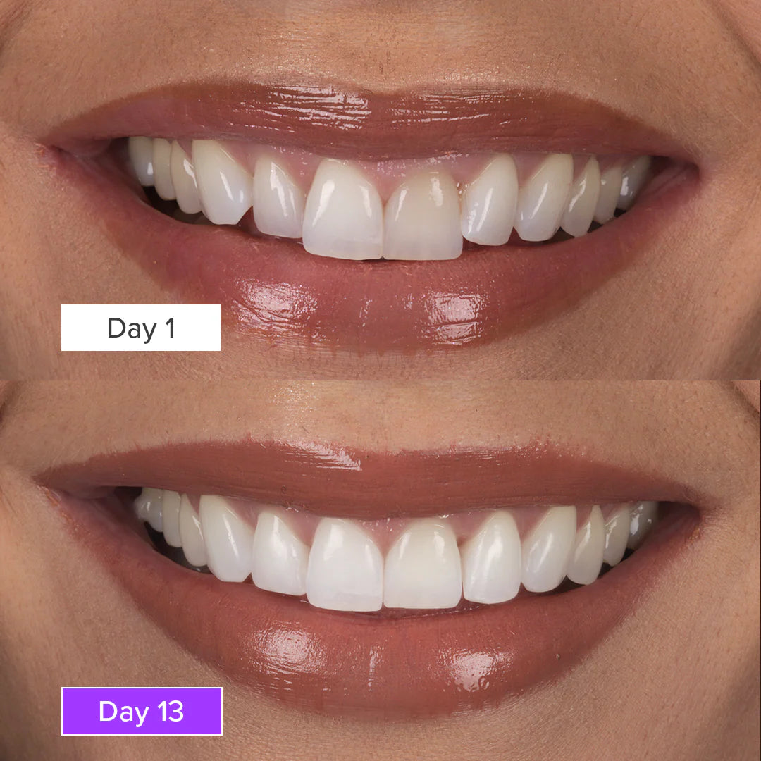 Smileva™ - Purple Teeth Whitening Strips