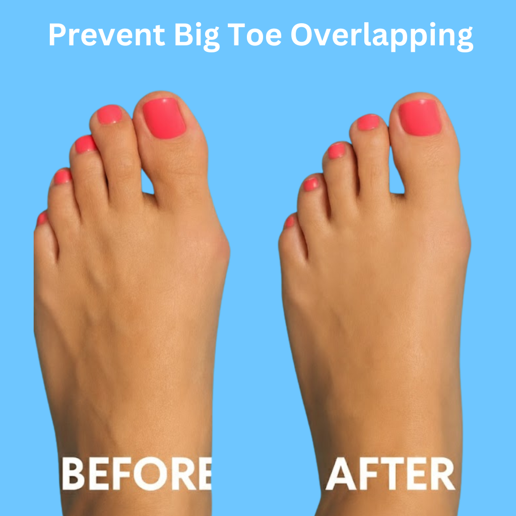 BuniFix™- Bunion Corrector Set