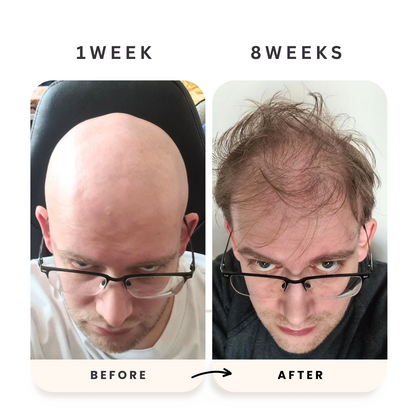 Celara™- Scalp Renewal Kit